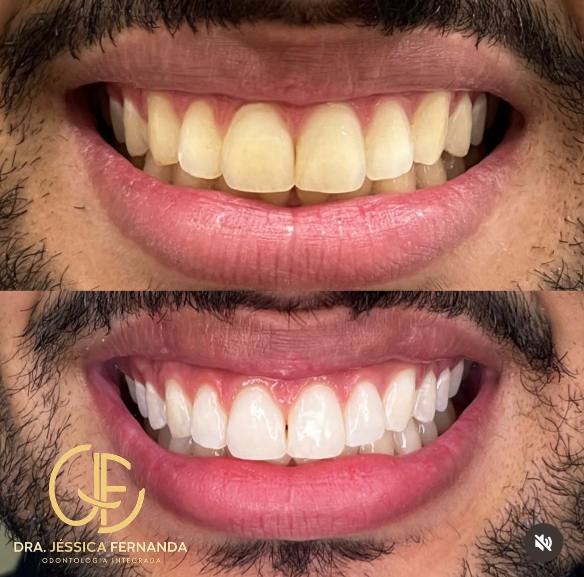 Clareamento dental