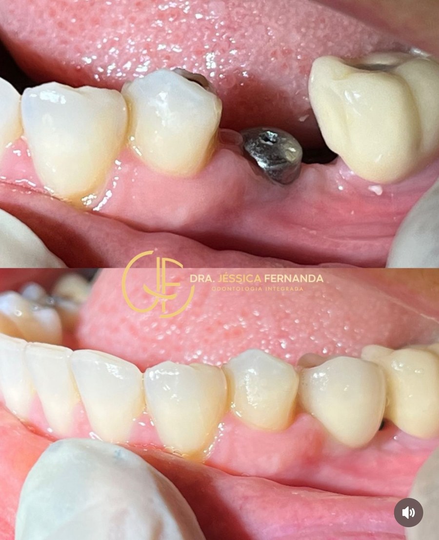 Implantes